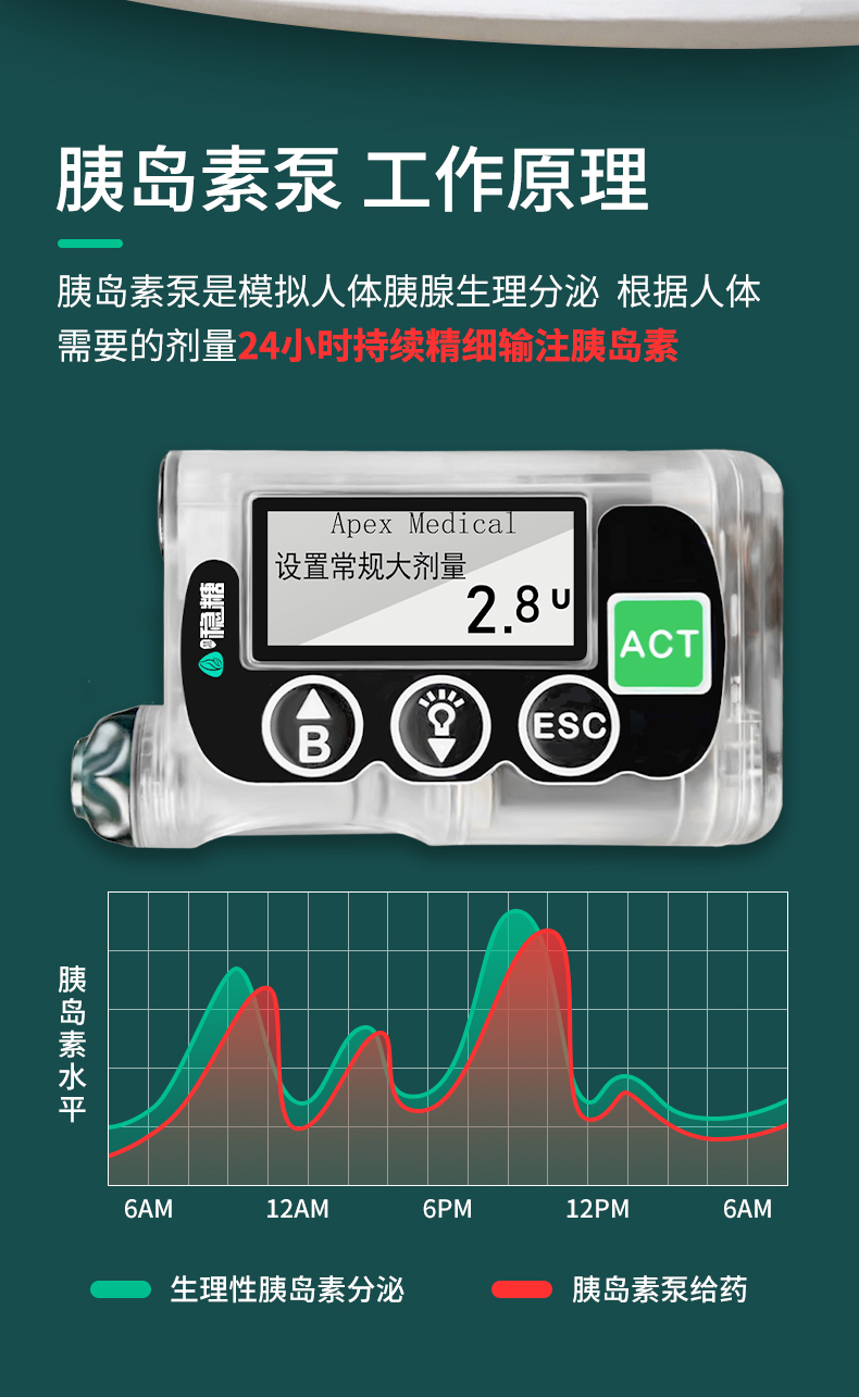 最新全自動胰島素泵，糖尿病管理的革命性進(jìn)步，全自動胰島素泵，糖尿病管理的突破性革新