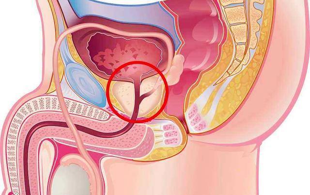 男性前列腺肥大，了解、識(shí)別與應(yīng)對(duì)，男性前列腺肥大，全面解析與應(yīng)對(duì)之道
