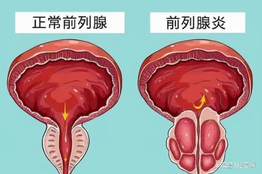 男性前列腺炎的癥狀解析，男性前列腺炎的癥狀詳解