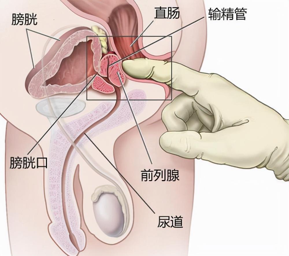 前列腺炎，重新認(rèn)識(shí)男性健康的誤區(qū)，重新認(rèn)識(shí)男性健康誤區(qū)，前列腺炎解析