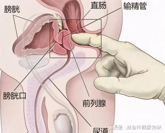 慢性前列腺炎，能否徹底治愈？解析與探討，慢性前列腺炎的治愈可能性解析與探討