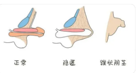 關于做包皮手術的費用分析，包皮手術費用詳解