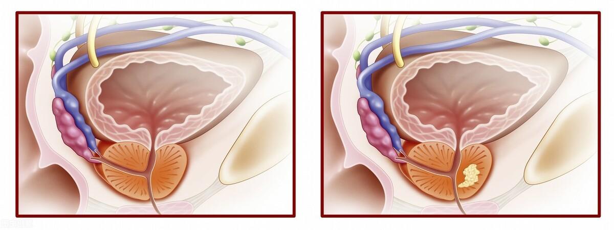 前列腺鈣化，揭示其潛在危害，前列腺鈣化，潛在危害揭秘