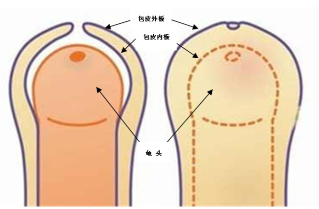 包莖及其相關(guān)圖片，了解、識別與處理，包莖詳解，圖片、識別、處理方法全攻略