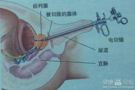 如何控制前列腺增生，如何控制前列腺增生的發(fā)展及癥狀？