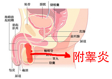 附睪炎，絕望中的希望曙光，附睪炎，絕望中的希望之光